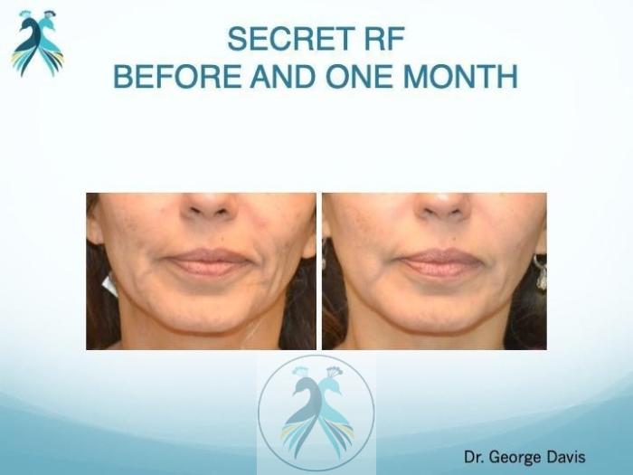 Before & After RF Microneedling Case 51 View 1 View in The Woodlands, TX