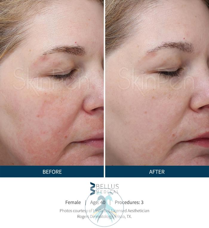 Before & After SkinPen® Microneedling Case 52 View 1 View in The Woodlands, TX