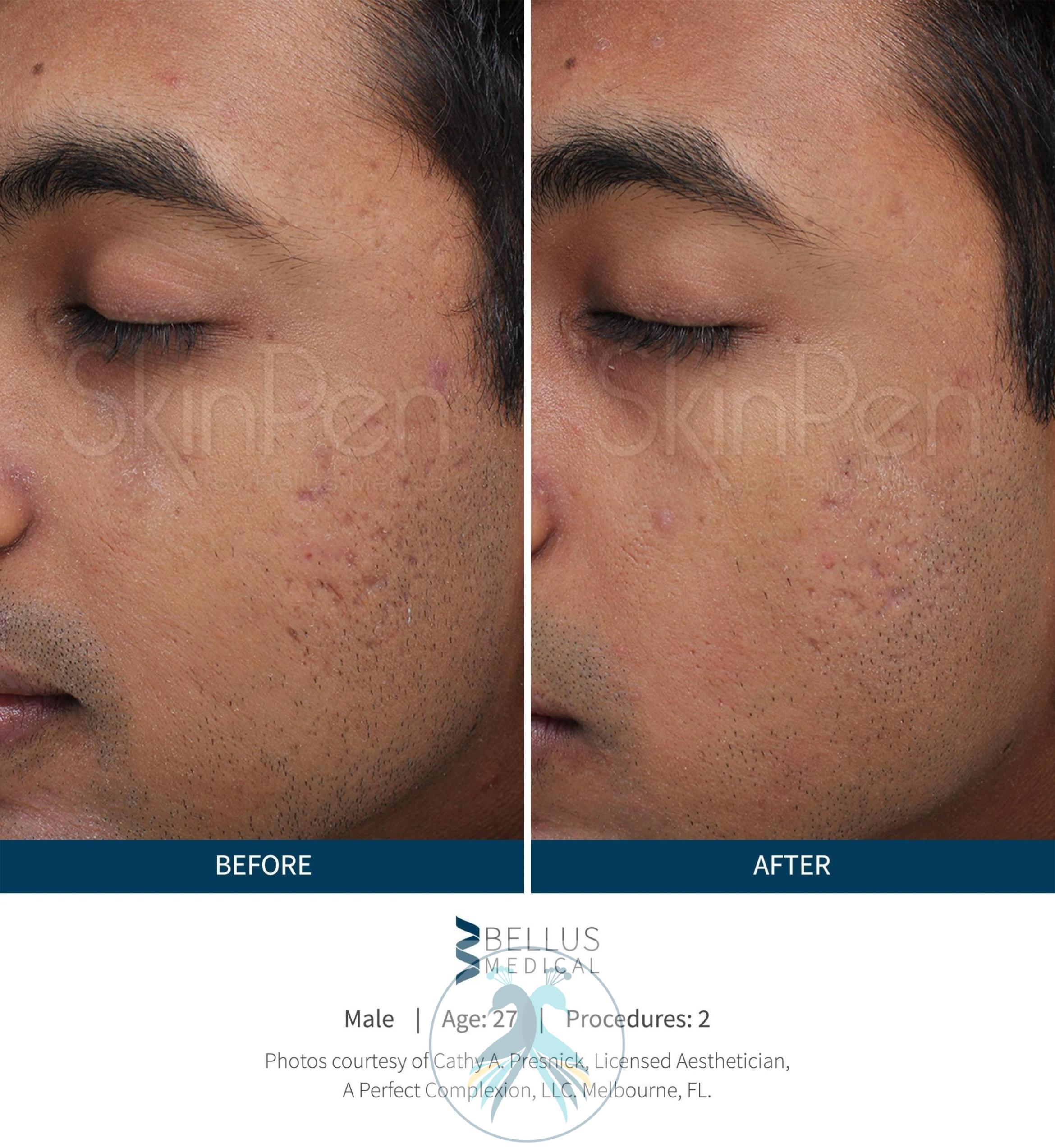 Before & After SkinPen® Microneedling Case 53 View 1 View in The Woodlands, TX