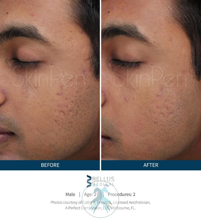 Before & After SkinPen® Microneedling Case 53 View 1 View in The Woodlands, TX