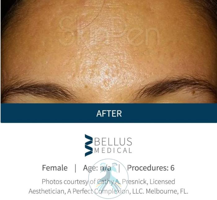 Before & After SkinPen® Microneedling Case 54 View 1 View in The Woodlands, TX