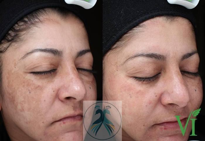 Before & After VI Peels Case 59 View 1 View in The Woodlands, TX