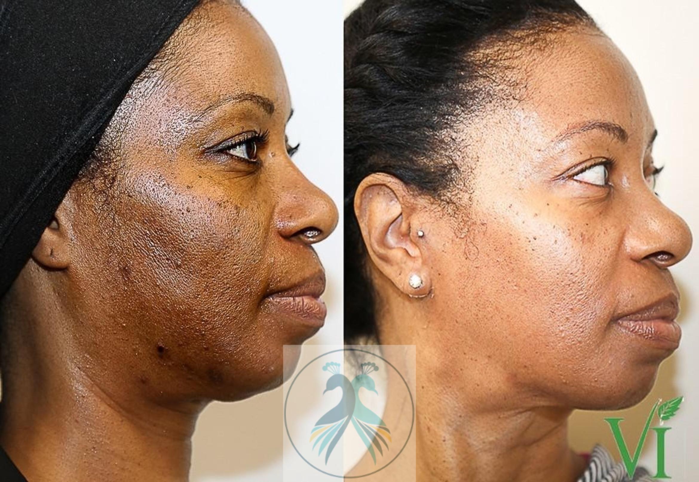 Before & After VI Peels Case 60 View 1 View in The Woodlands, TX