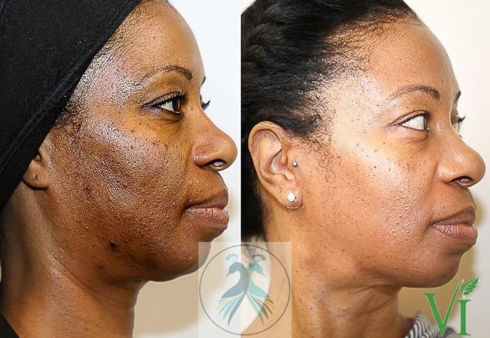 Before & After VI Peels Case 60 View 1 View in The Woodlands, TX