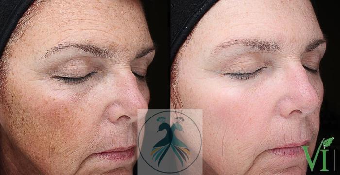 Before & After VI Peels Case 61 View 1 View in The Woodlands, TX