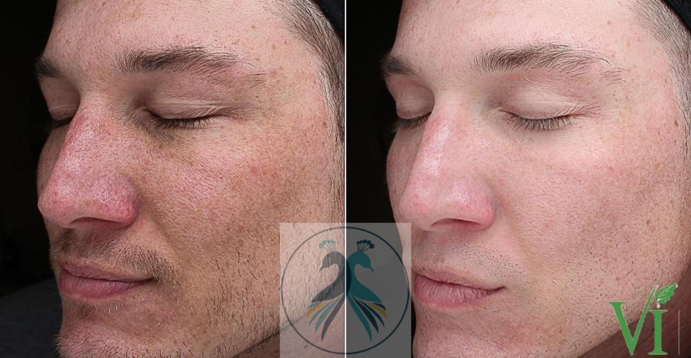 Before & After VI Peels Case 62 View 1 View in The Woodlands, TX