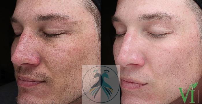 Before & After VI Peels Case 62 View 1 View in The Woodlands, TX